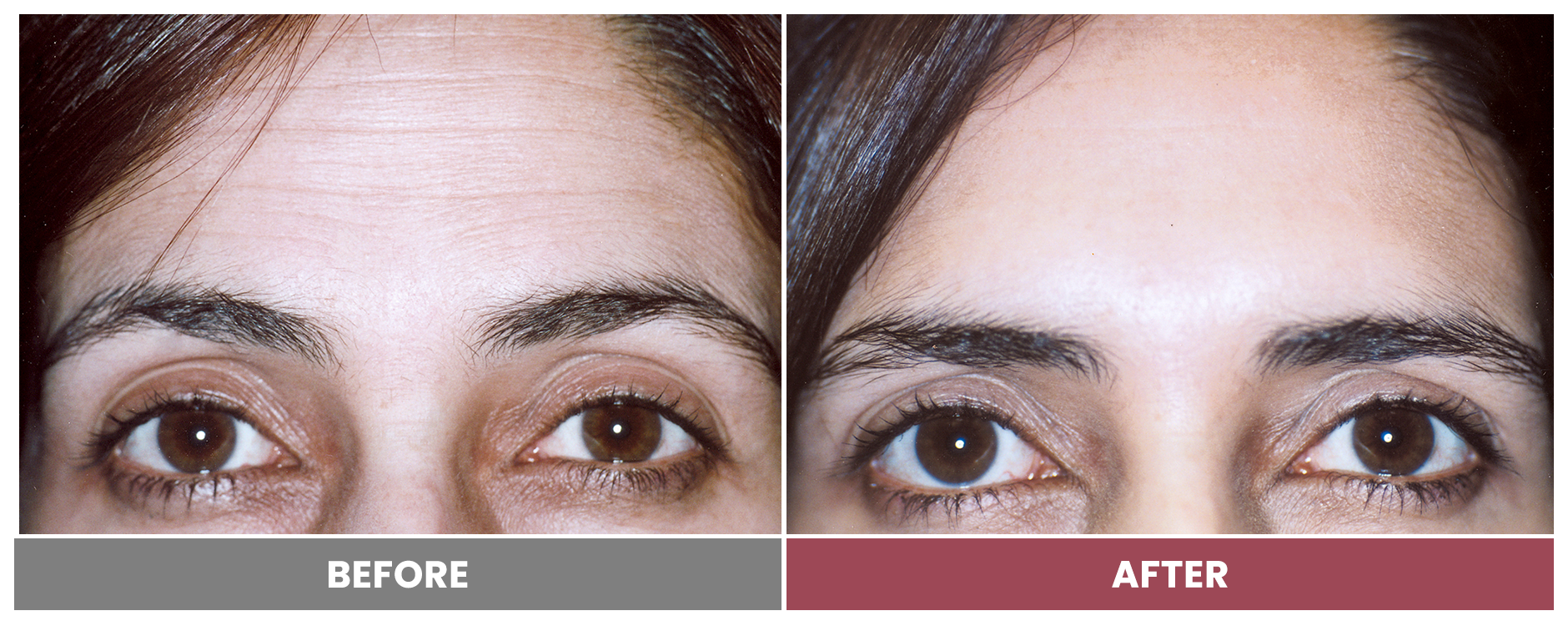 BOTOX FOR WRINKLES & BROW LIFT - Case 17